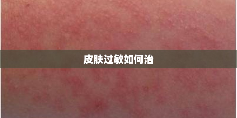 皮肤过敏如何治
