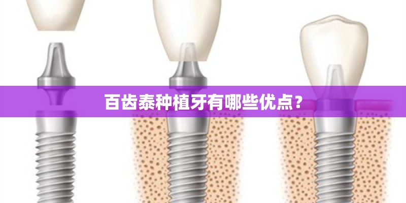 百齿泰种植牙有哪些优点？