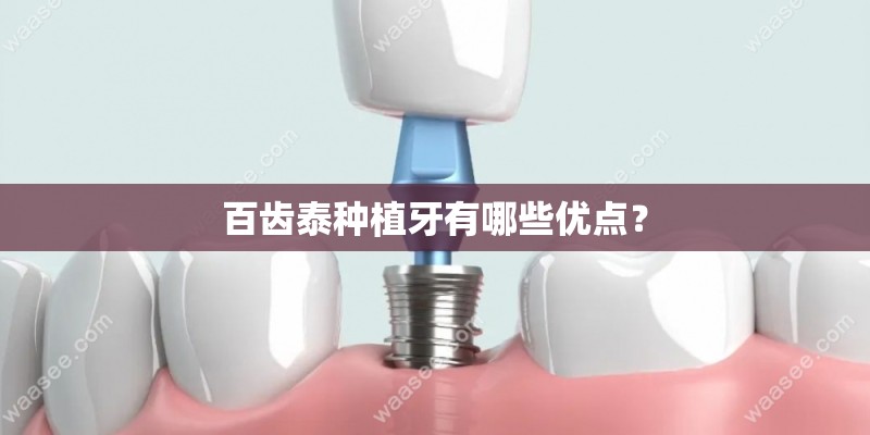 百齿泰种植牙有哪些优点？